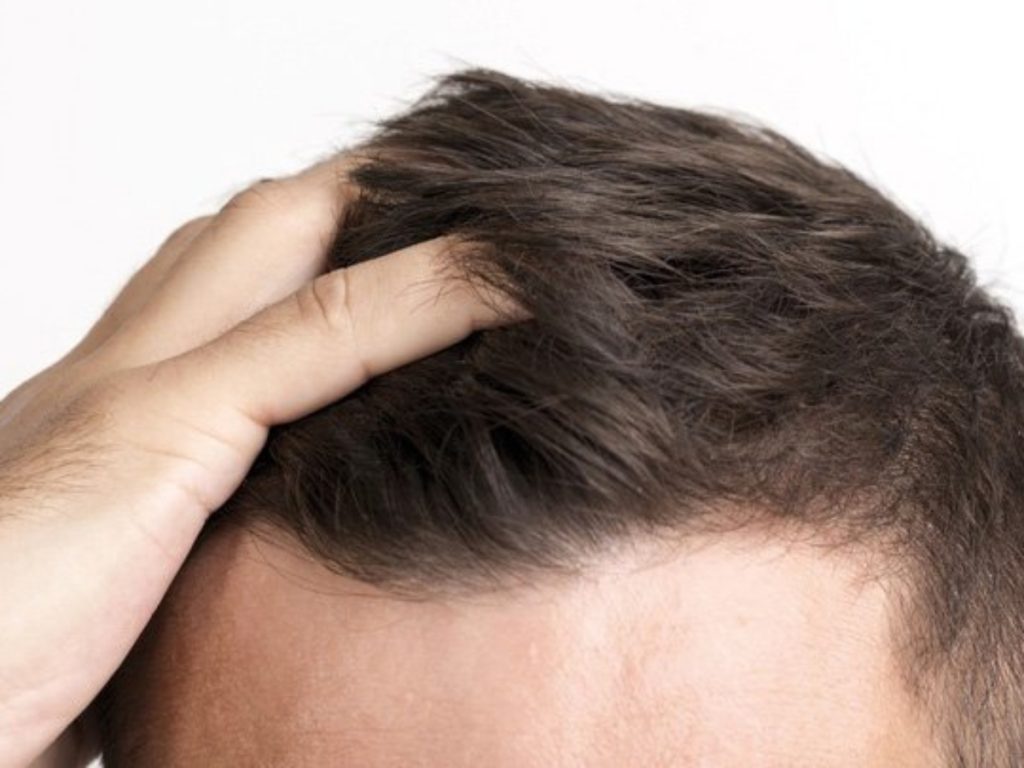 injerto de pelo
