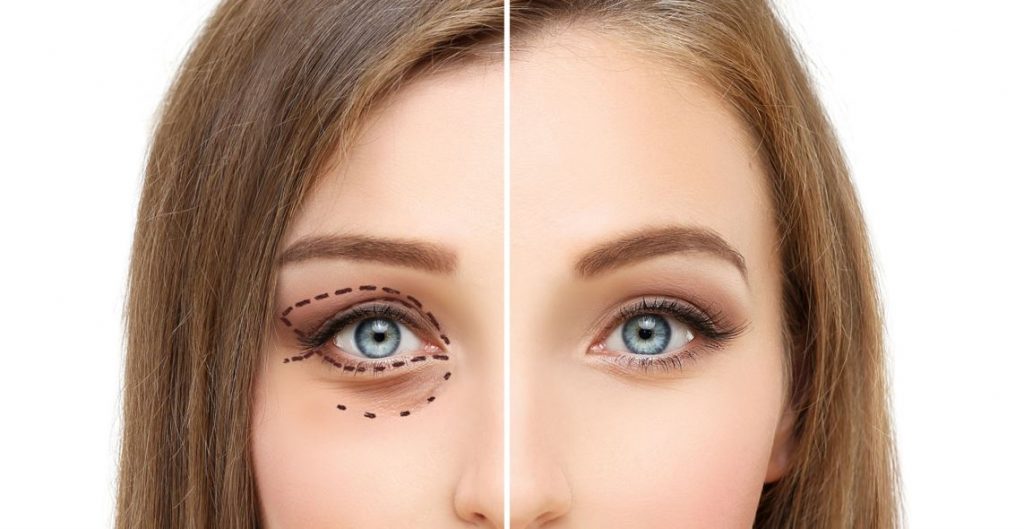blefaroplastia en granada